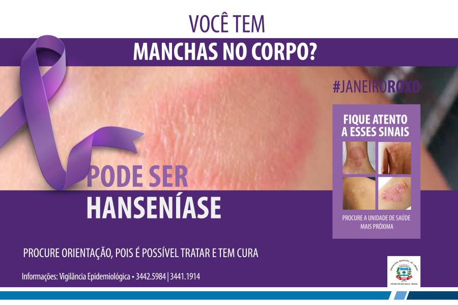 Campanha conscientiza sobre tratamento e sintomas da hanseníase