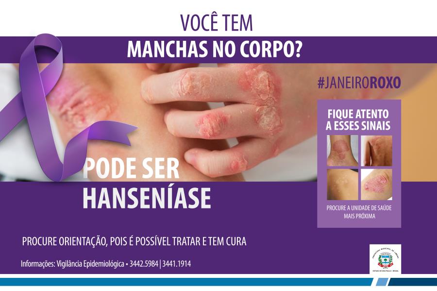 Hanseníase - descubra quais são aa causas, sintomas e tratamento 