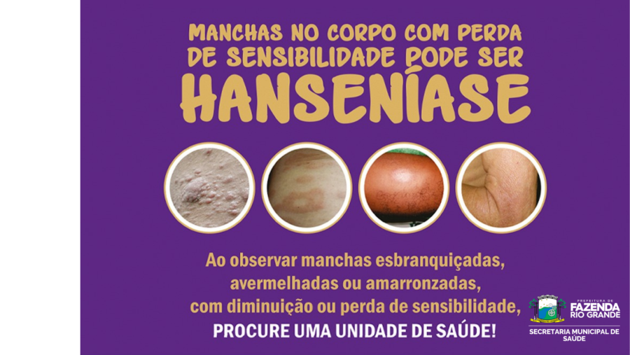 Janeiro Roxo: Prefeitura realiza ações de combate à Hanseníase